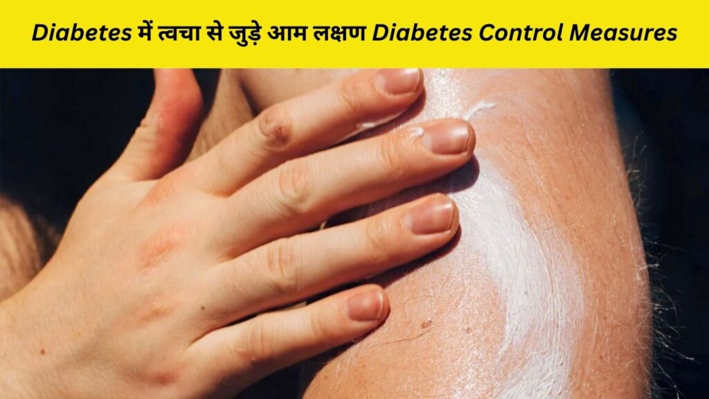 Diabetes में त्वचा से जुड़े आम लक्षण Diabetes Control Measures